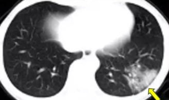 辽宁朝阳新冠肺炎 小儿肺炎
