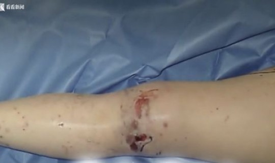 日本 感染(日本病是什么病)