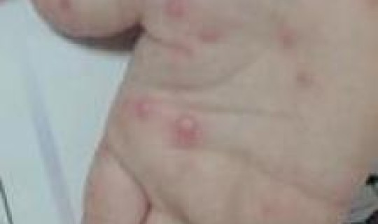 感染新冠之后多久会传染？感染艾滋病毒多久会有症状