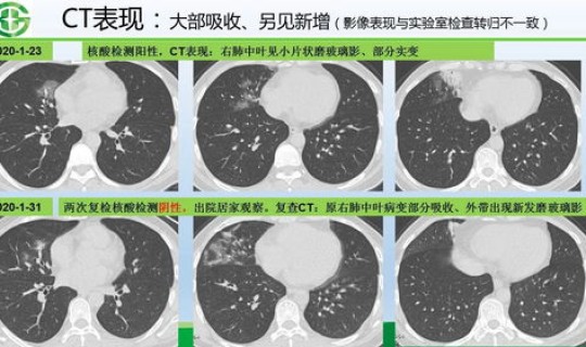 陕西冠状病毒肺炎多少例 新型冠状病毒肺炎感染