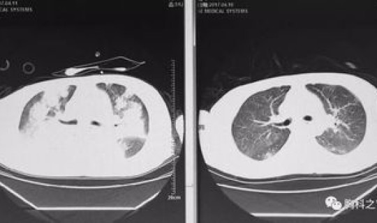 上海有多少人感染了病毒肺炎(病毒性肺炎症状有哪些)