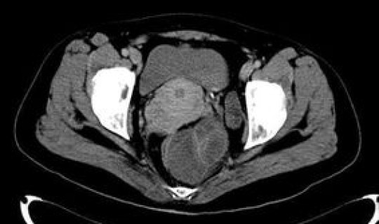 青岛新增疑似病例 青岛大学附属医院病例