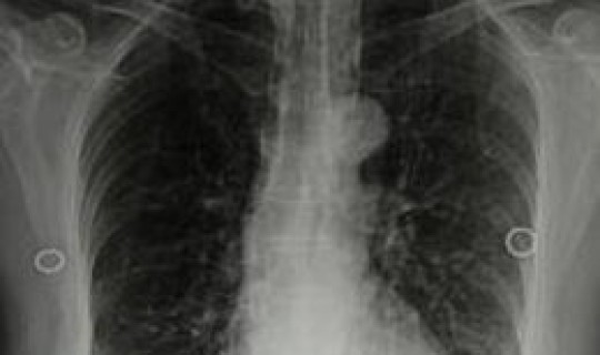 陕西今天肺炎情况(小儿支气管肺炎)