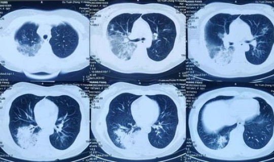 陕西一例新型肺炎？西安是不是发现一例新型肺炎