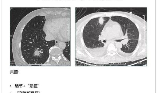 重庆新冠病毒情况是怎样的？冠状病毒肺炎