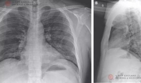 美国新冠肺炎今日情况？新型肺炎症状
