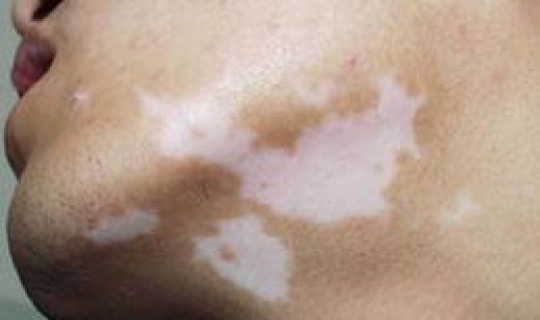 青岛 本地确诊 青岛确诊白癜风