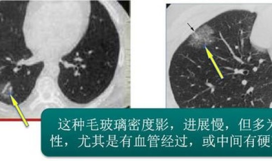 都会复发吗？癌症复发还是原来癌症吗