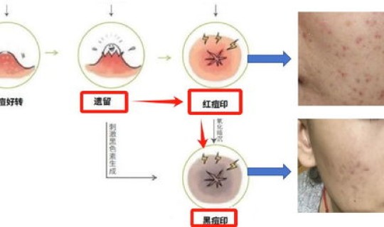 猴痘怎么治疗，也称猴豆