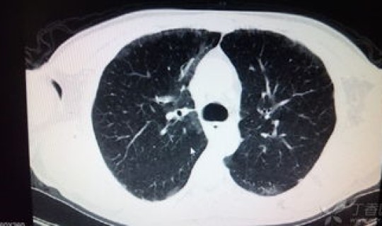 河南哪有一例肺炎，河南第一例肺炎