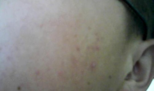 苏州感染者症状(感染hiv初期症状)