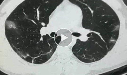 新冠无症状感染者会传染吗 新冠无症状者一般多长时间核酸转阴？