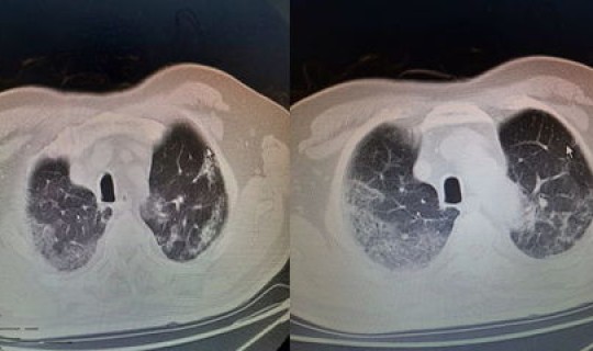昆明两例肺炎？肺炎是怎么引起的
