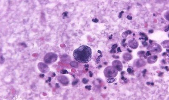 新型肺炎第二波爆发期是多久(肺炎的急性期是指什么时间)