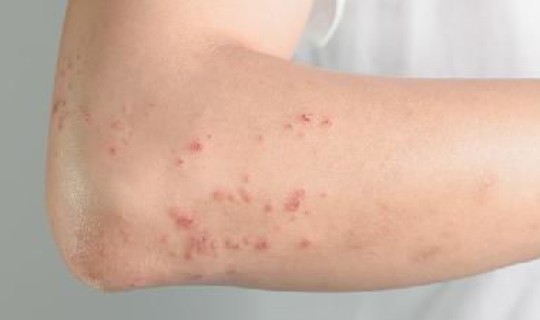 郑州感染者症状(感染hiv初期症状) 郑州感染者症状(感染hiv初期症状)