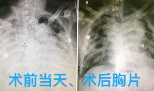 茂名有发现新冠型肺炎 新冠性肺炎症状