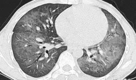 花都区有新冠肺炎，新冠状肺炎的早期症状