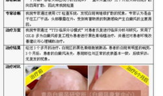 青岛确诊疫情？青岛确诊白癜风