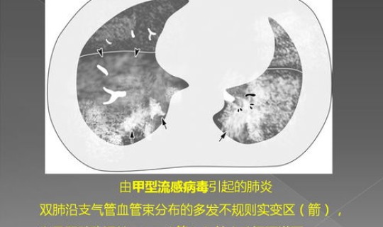 成都一例新型冠状病毒(成都最近流行的病毒)