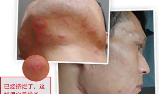 在越南感染，越南目前病情严重吗