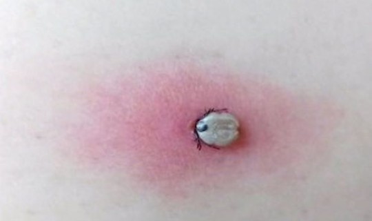 河南2人被感染，感染