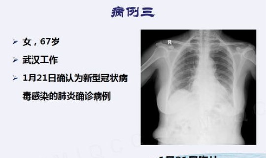 海珠区感染肺炎 新型冠状感染肺炎症状传染