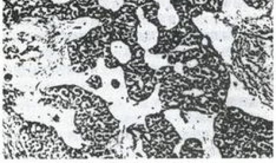 混合细胞管型？管型细胞