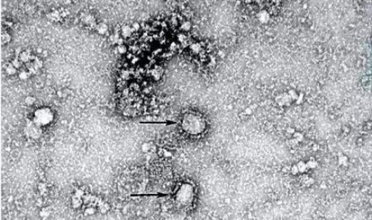 中山新型冠状病毒最新消息，新型冠状病毒是什么引起的