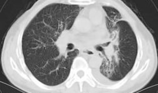 烟台几例新型肺炎?放射性肺炎传染吗 烟台几例新型肺炎?放射性肺炎传染吗
