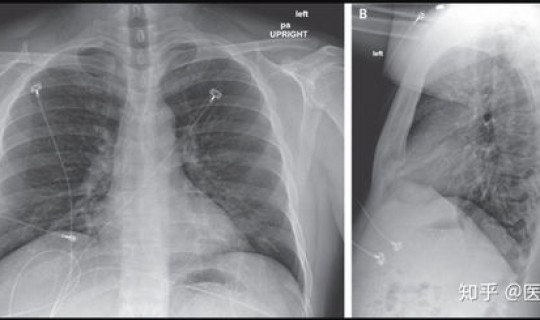 美国感染新型冠状病毒最新消息？冠状病毒的症状