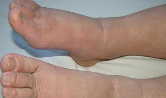 无症状感染者病发症状(艾滋病前兆有哪些症状)