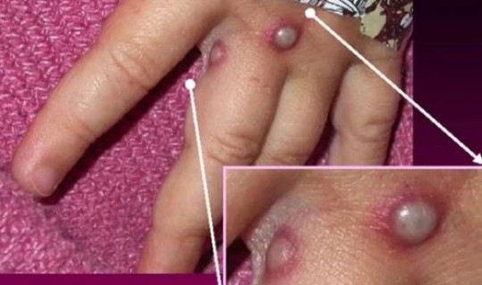 猴痘病毒的临床症状与天花相似？什么是猴痘病病毒