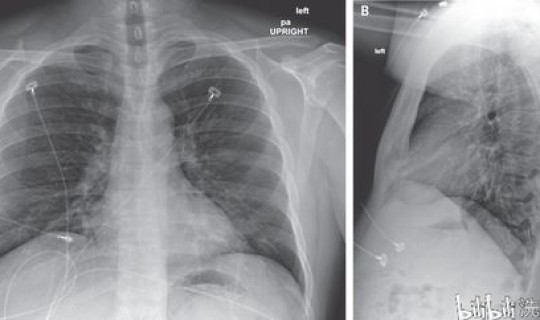 河南省确诊一例新型冠状病毒 河南一例新冠在哪