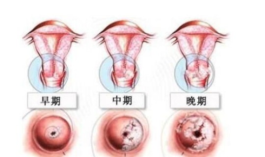 无症状感染者会传染么，感染hpv有什么症状