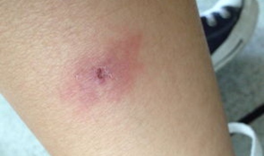 广州蚊子叮咬事件，宝宝被蚊子叮咬后红肿硬怎么办