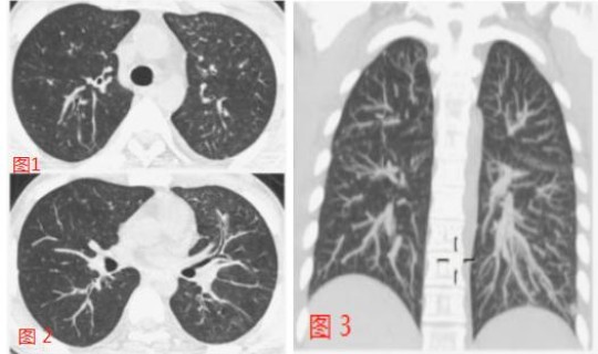 江苏病毒性肺炎最新消息，苏州3例新型肺炎在哪里