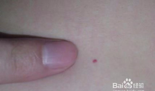 无症状感染者无症状的原因？感染hiv初期症状