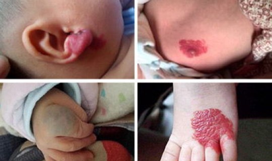 无症状患者会传染？生殖疱疹会传染家人吗