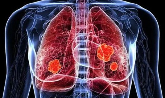 感染新冠的死亡率是多少(病毒性肺炎死亡率)