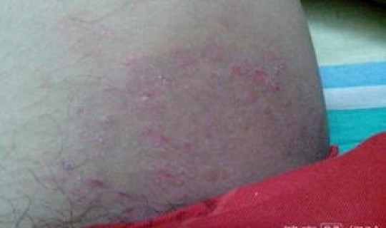 无症状感染比例高吗(艾滋病感染几率高不高)