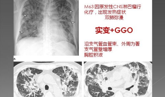 韩国单位第一例新冠状肺炎(关于新型冠状病毒感染的肺炎)