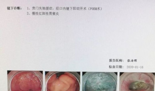 河北新冠状肺炎(河北省第一例新冠患者)