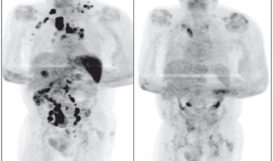 感染新冠多久不会传染人了呢(新冠多少天后不会传染人)