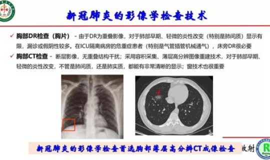 苏州新冠肺炎情况 新冠状肺炎的早期症状