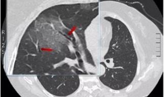 湖南新型冠状病毒性肺炎最新消息 湖南澧县例新型肺炎患者是哪里的