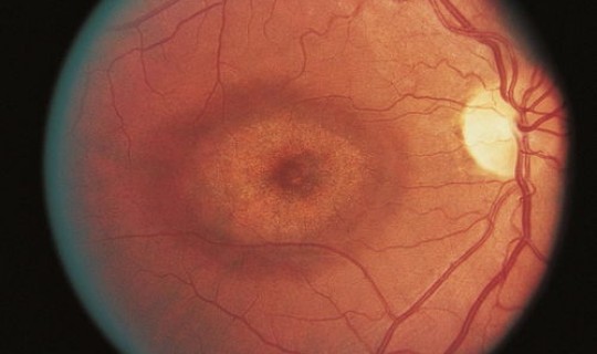 隐匿性病变是什么意思(惰性的癌症是什么意思)