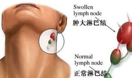 肠系膜淋巴结炎是什么病毒引起的(肠系膜淋巴结炎是怎么引起的)
