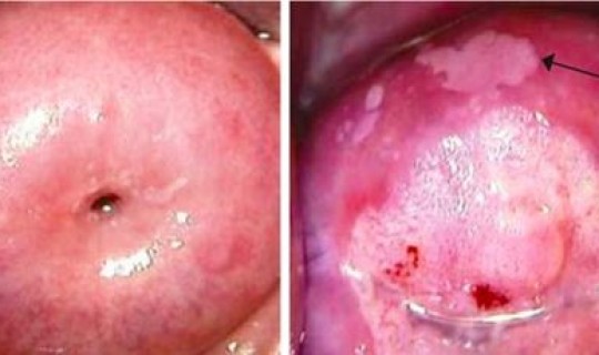hpv感染一个月可以检测出来嘛？hpv感染几天能检测出来