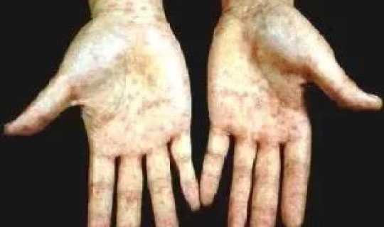 确诊无症状梅毒医生说没事 无症状神经梅毒能治愈吗是什么原因引起的